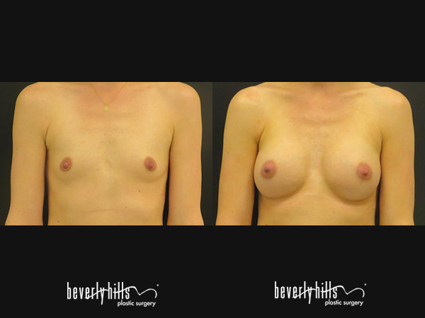 breast_augmentation-1g