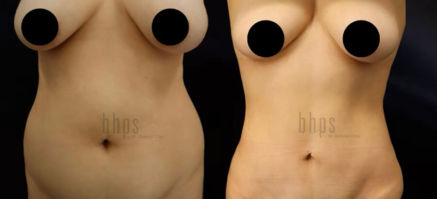 Tummy Tuck Patient 27 Before & After