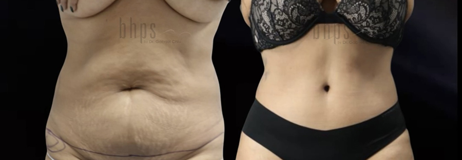 Tummy Tuck Patient 28 Before & After