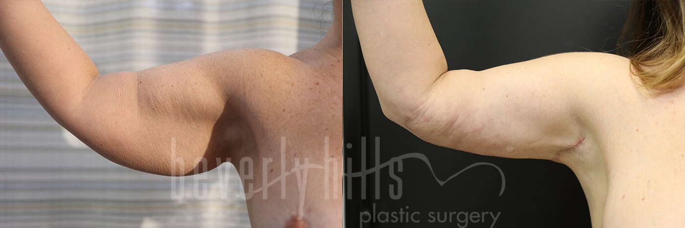 Arm Lift Patient 06 Before & After