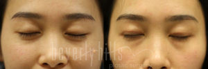 Blepharoplasty Patients 06 Before & After - Thumbnail