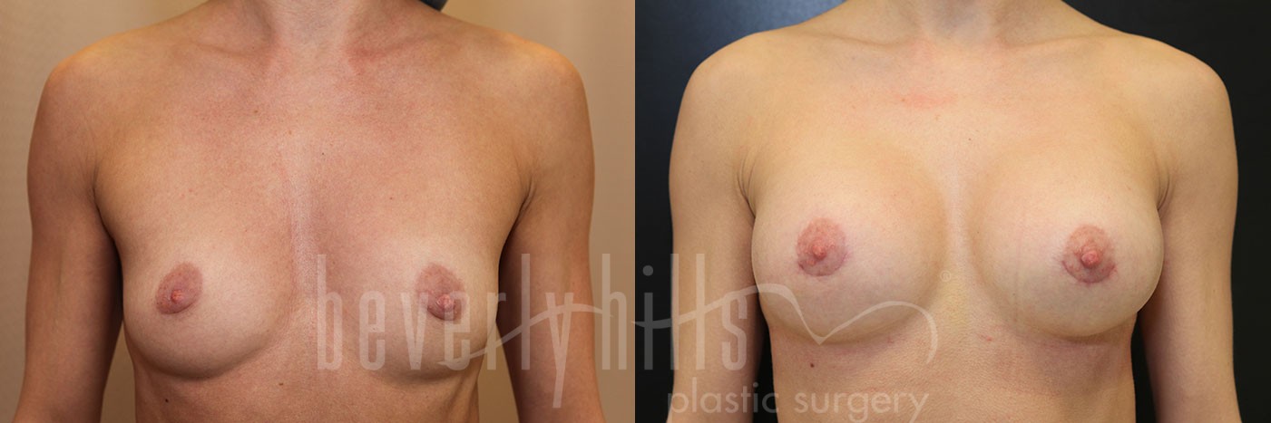Breast Augmentation 35 Before & After