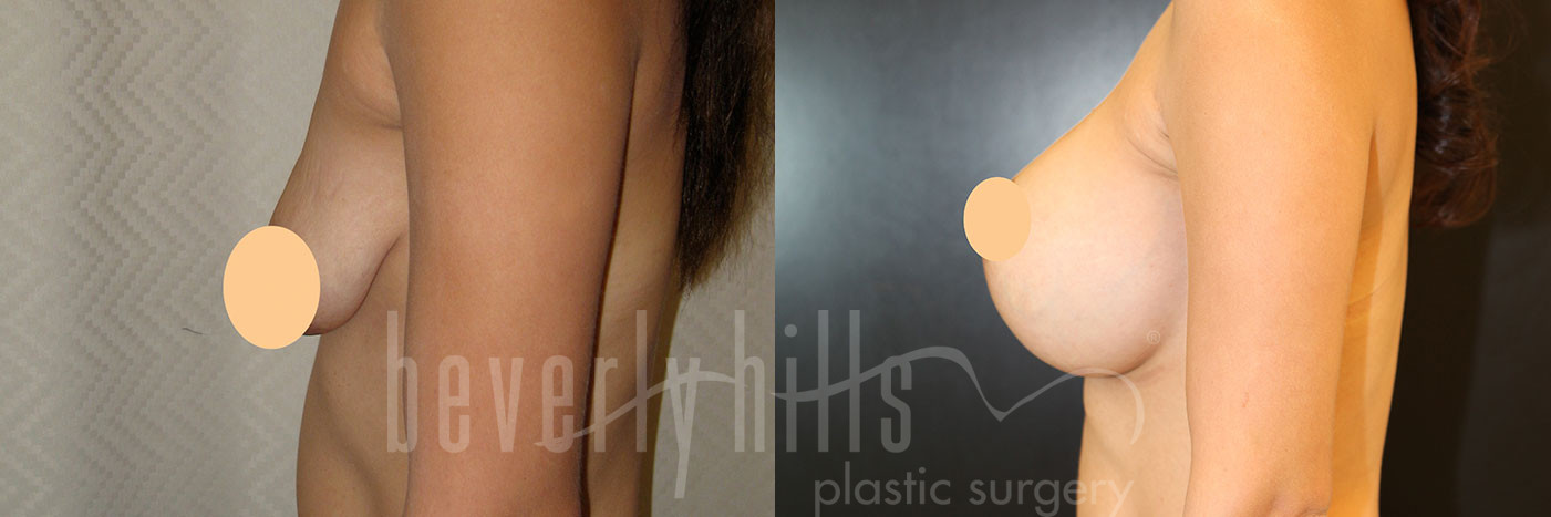 Breast Lift 05 Before & After