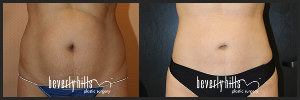 Before and after female liposuction (front)-4