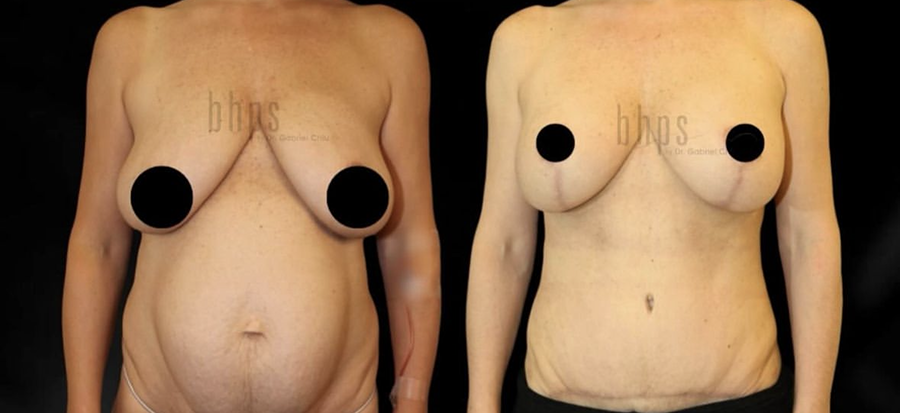 Mommy Makeover Patient 07 Before & After