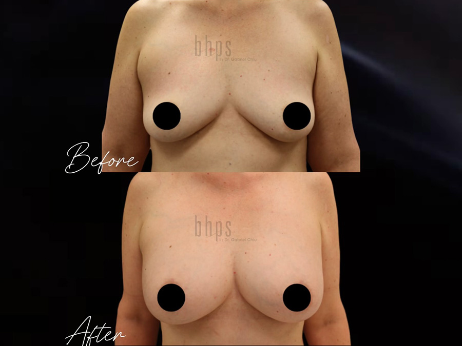 Fat Transfer Patient 05 Before & After