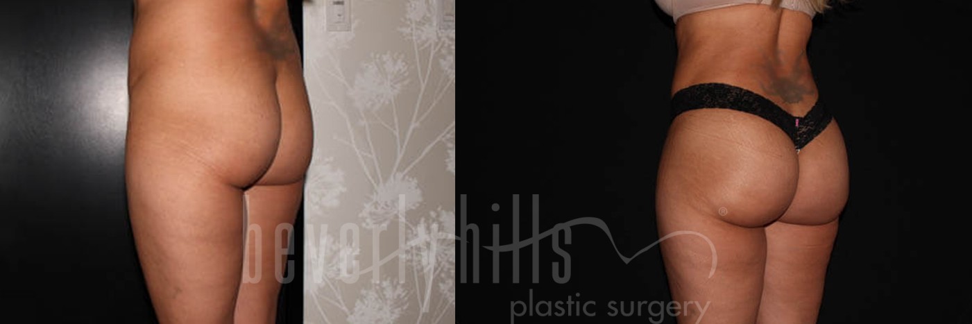 Brazilian Butt Lift Patient 01 Before & After