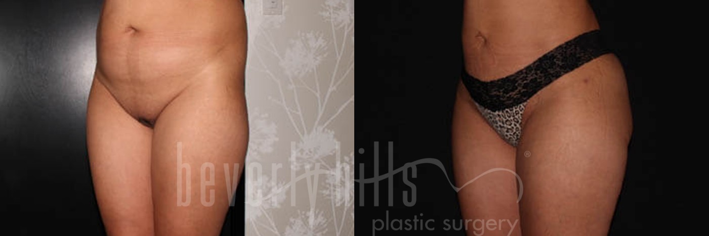 Brazilian Butt Lift Patient 01 Before & After