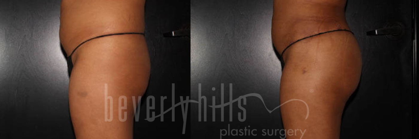 Brazilian Butt Lift Patient 07 Before & After