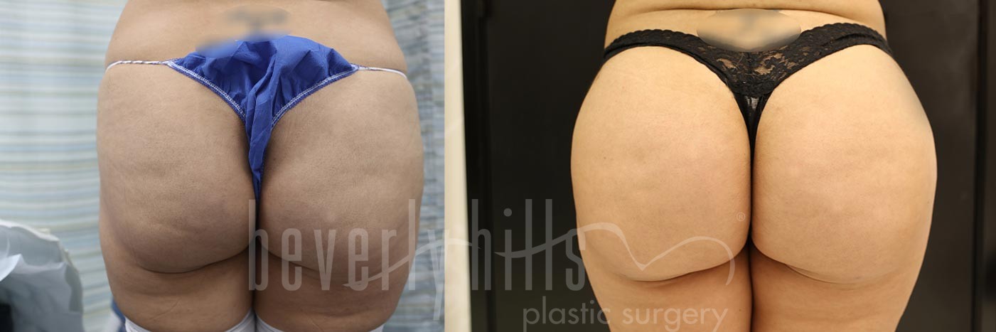 Brazilian Butt Lift Patient 27 Before & After