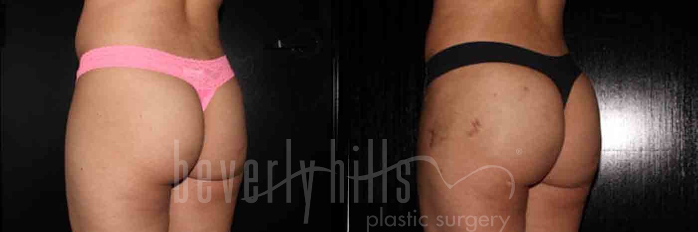 Brazilian Butt Lift Patient 20 Before & After