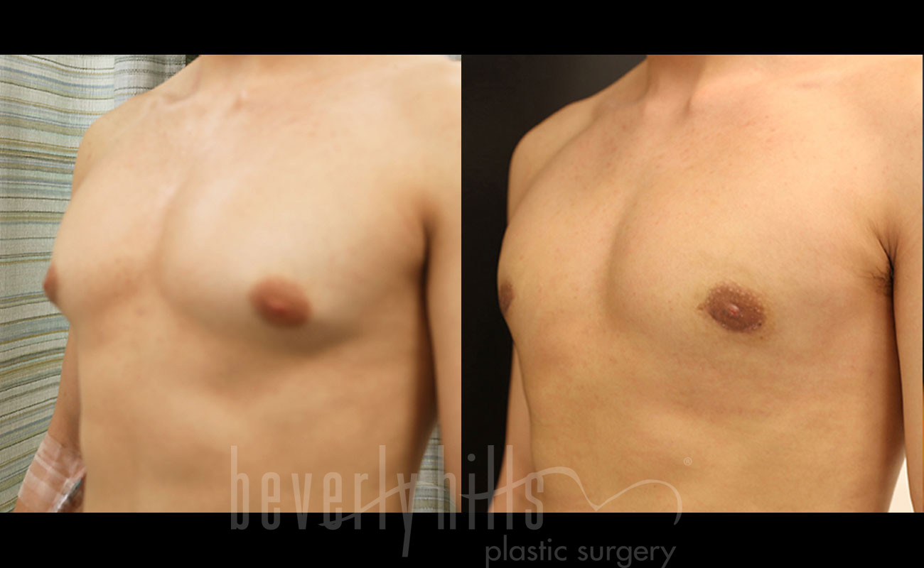 Gynecomastia Patient 16 Before & After