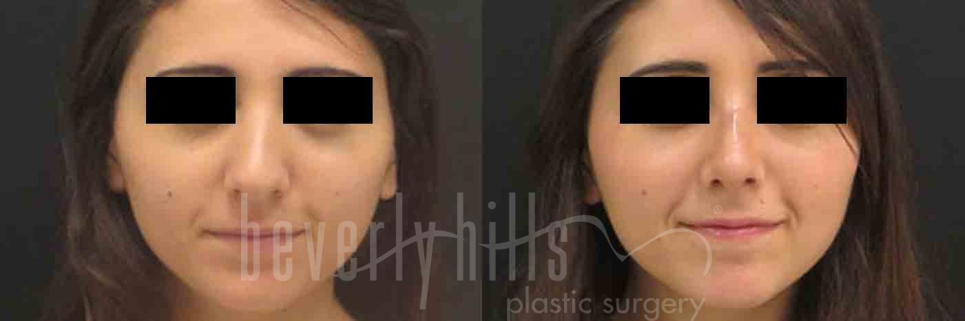 Rhinoplasty Patient 05 Before & After