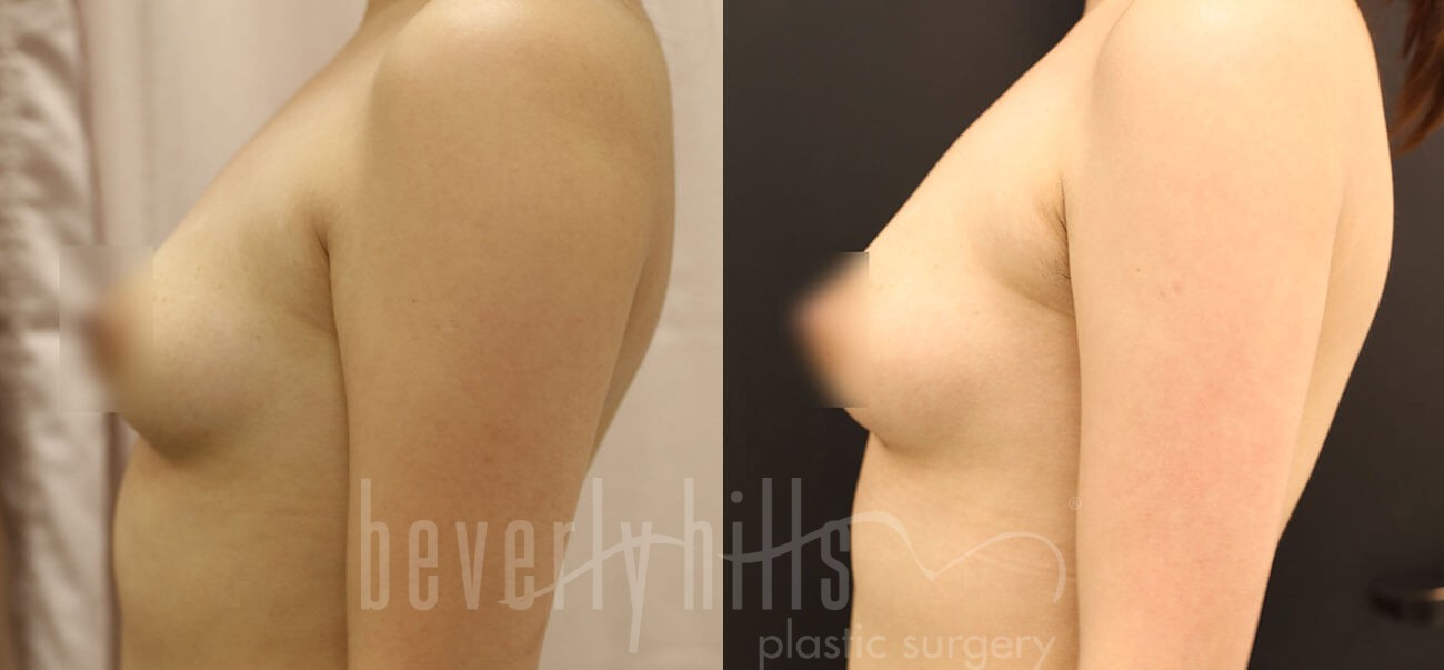 Fat Transfer Patient 01 Before & After