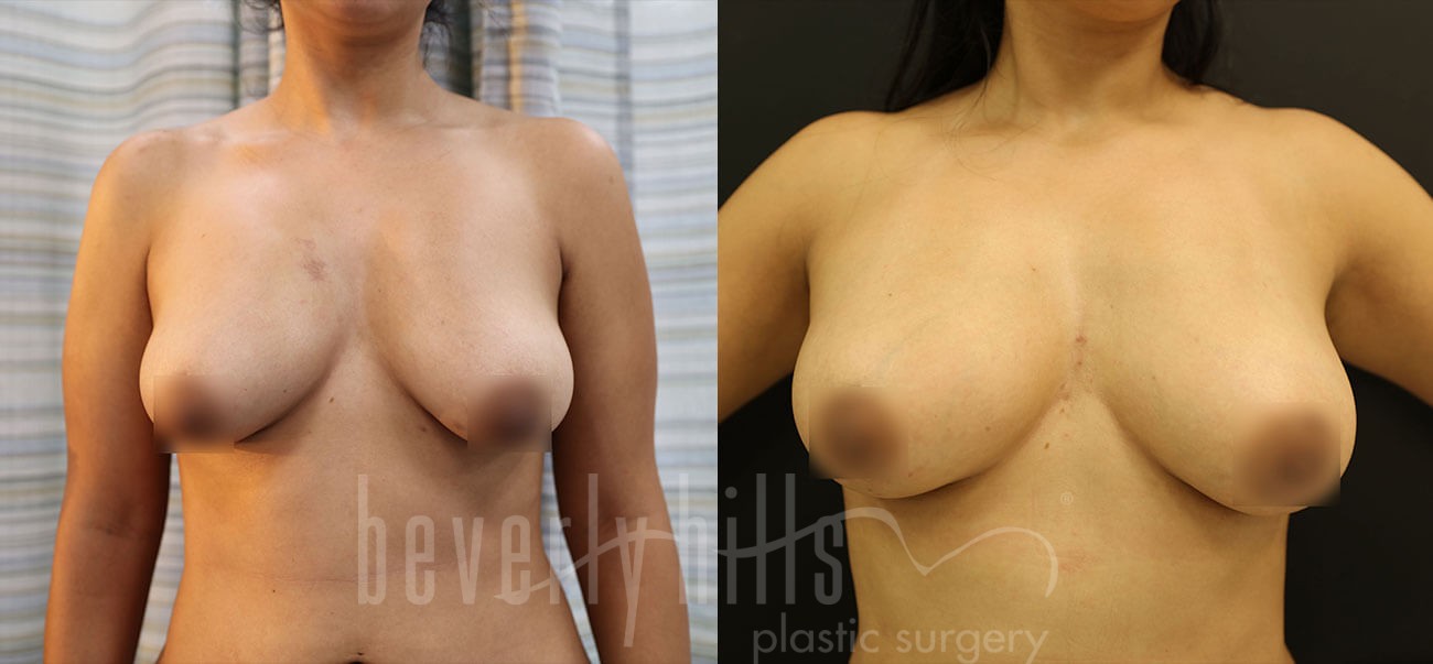 Fat Transfer Patient 04 Before & After