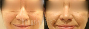 Rhinoplasty Patient 32 Before & After - Thumbnail